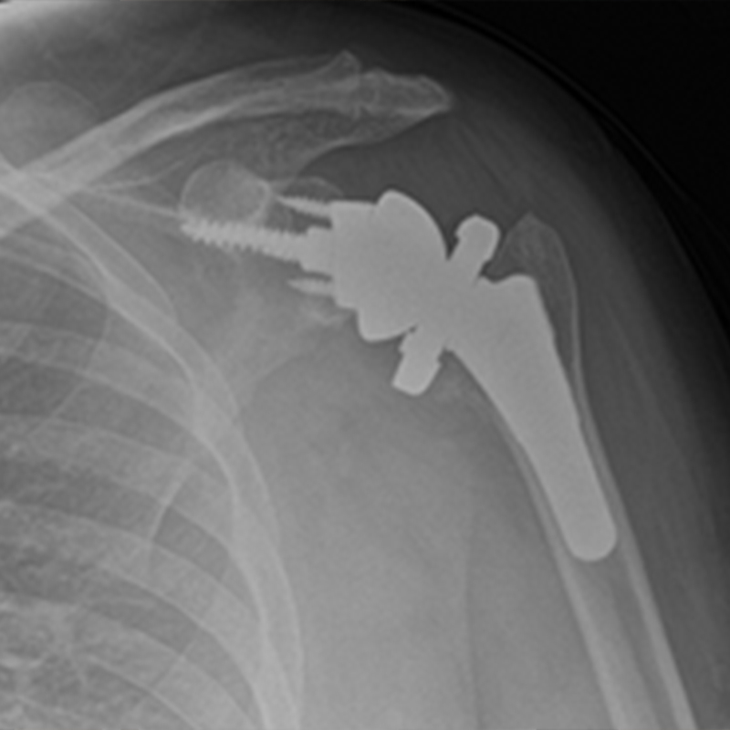 Shoulder Replacement